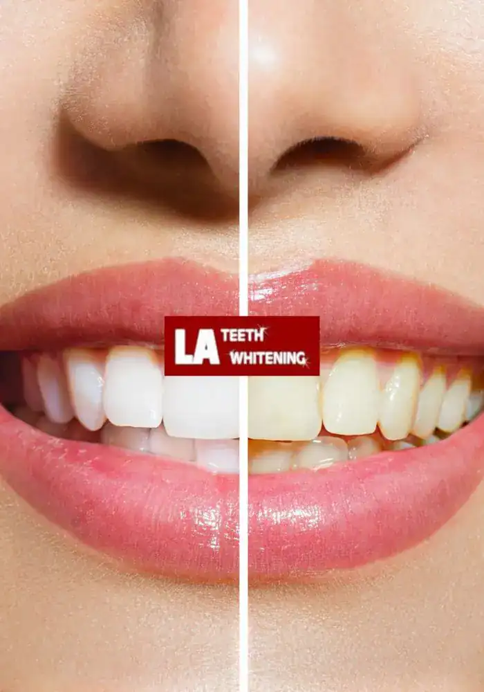 What’s the Cost Advantage of Whitening Before Cosmetic Procedures Coalville