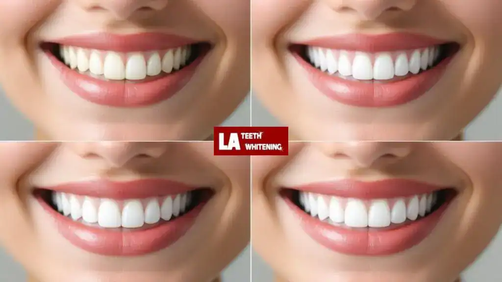 Does Whitening First Really Make a Difference in Your Final Smile Shade? Coalville