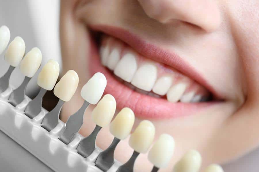 Why You Should Whiten Before Cosmetic Dental Work Coalville